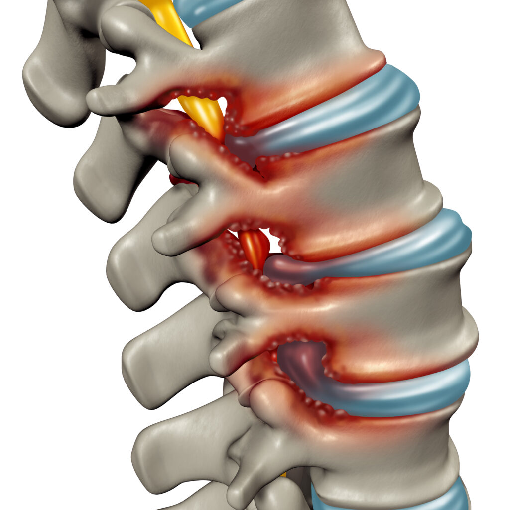 Can Lumbar Spinal Stenosis Affect Balance